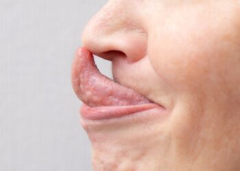 23 signs you grew up with ehlers-danlos syndrome