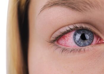 my boyfriend came in my eye and now it's red