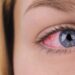 my boyfriend came in my eye and now it's red